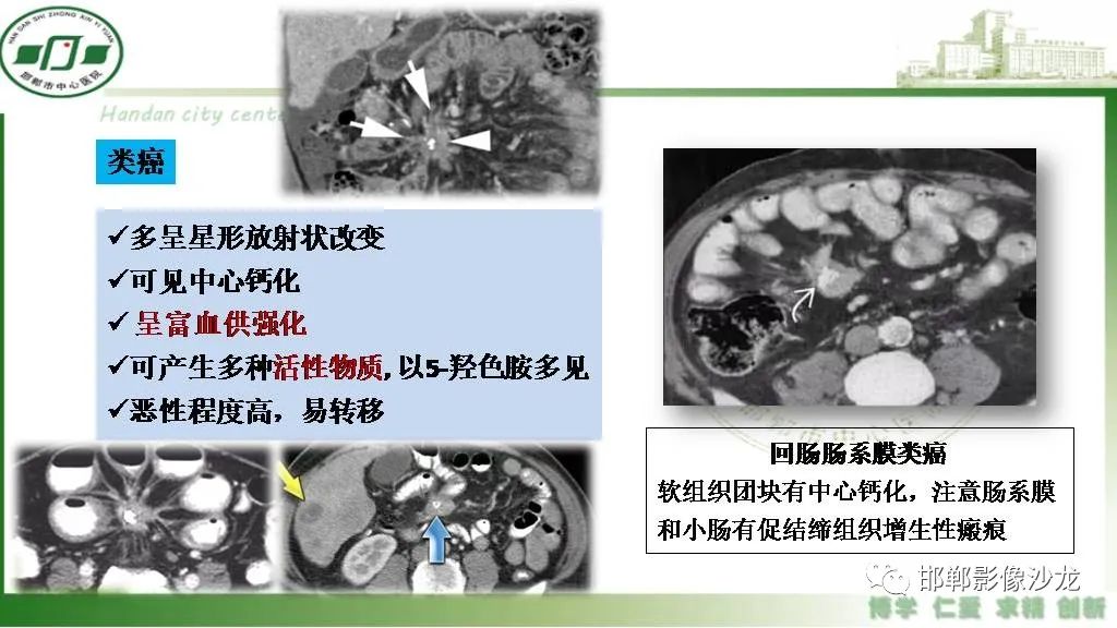 影像PPT - 【PPT】硬化性肠系膜炎-32