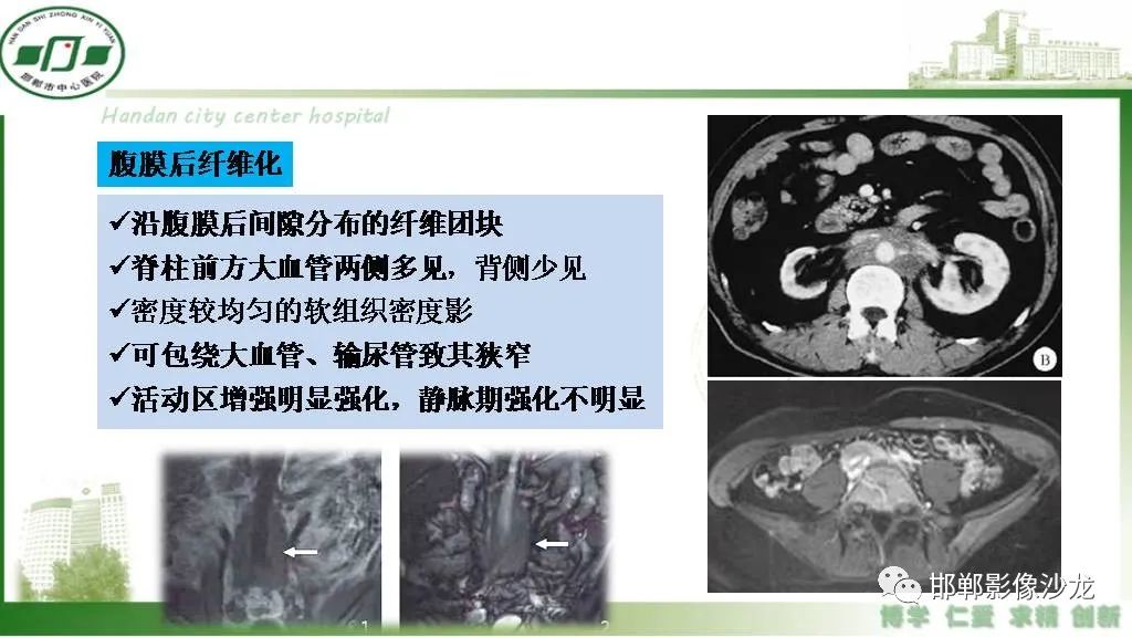 影像PPT - 【PPT】硬化性肠系膜炎-34