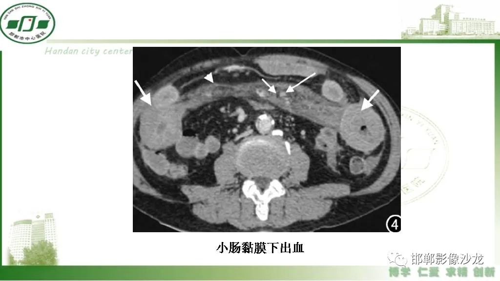 影像PPT - 【PPT】硬化性肠系膜炎-38