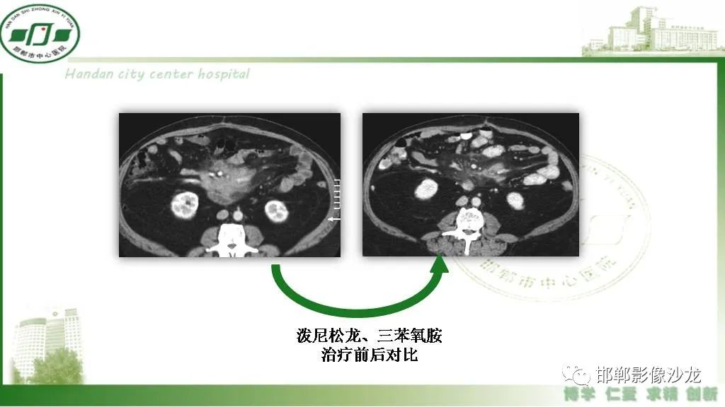 影像PPT - 【PPT】硬化性肠系膜炎-40