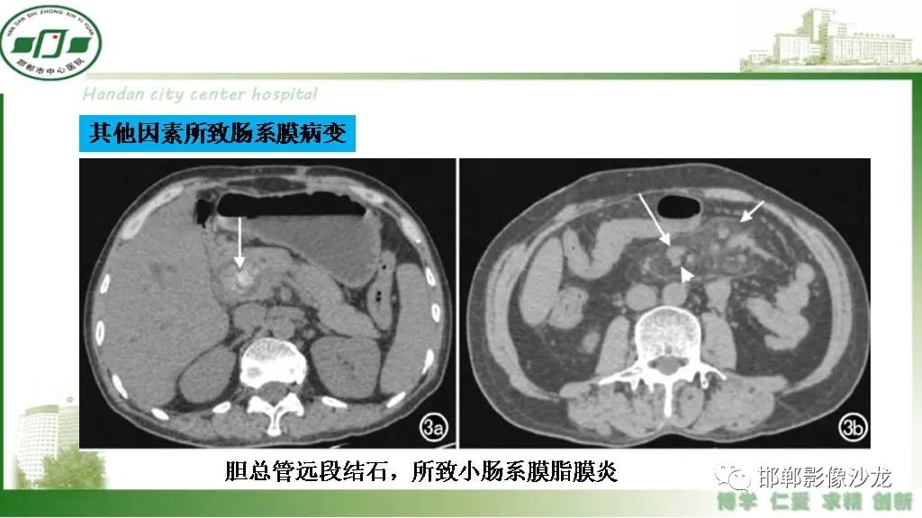 影像PPT - 【PPT】硬化性肠系膜炎-37