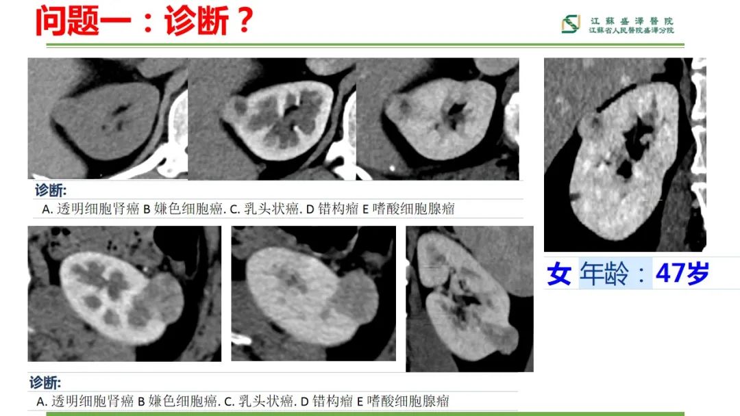 影像PPT - 【PPT】肾脏实性肿瘤的良恶性鉴别--影像诊断思路分析-3