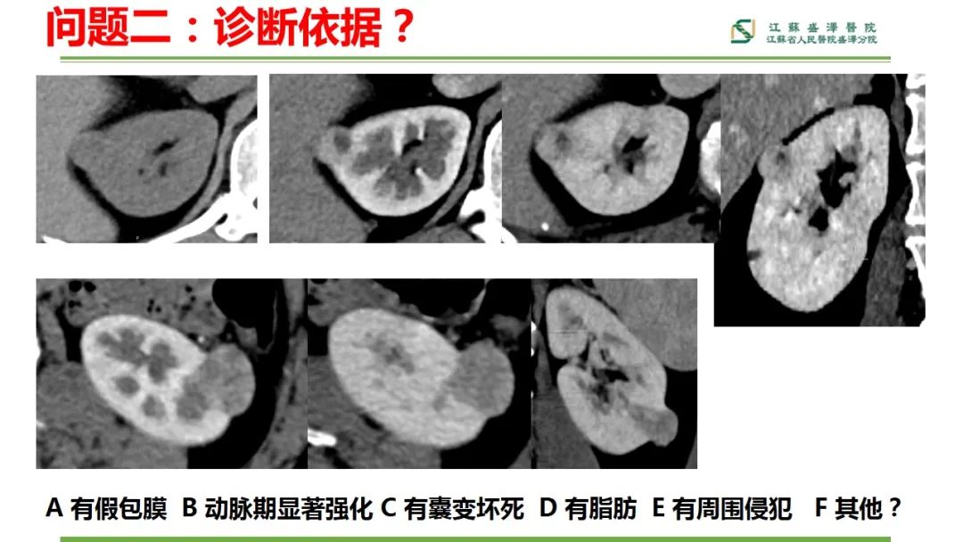 影像PPT - 【PPT】肾脏实性肿瘤的良恶性鉴别--影像诊断思路分析-4