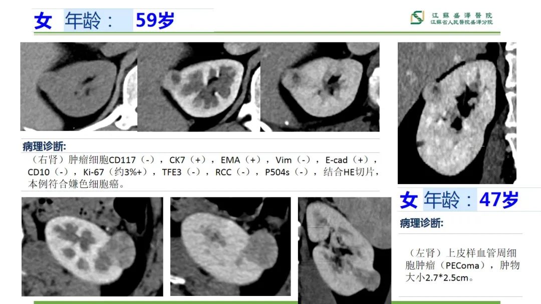影像PPT - 【PPT】肾脏实性肿瘤的良恶性鉴别--影像诊断思路分析-5