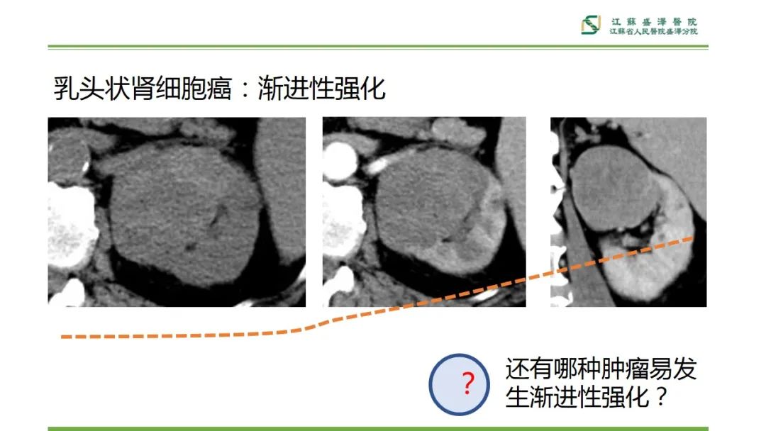 影像PPT - 【PPT】肾脏实性肿瘤的良恶性鉴别--影像诊断思路分析-12