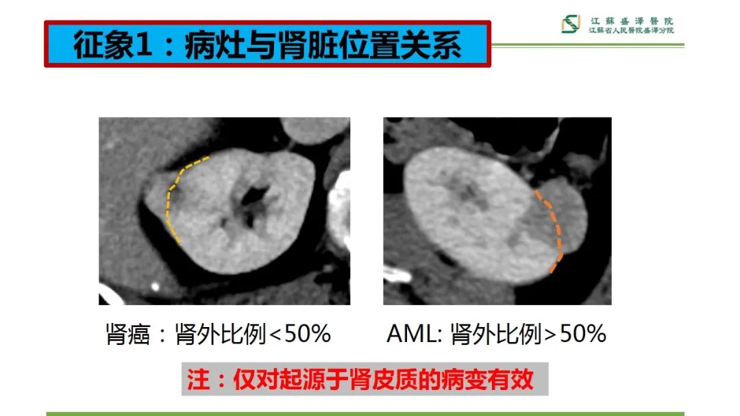 影像PPT - 【PPT】肾脏实性肿瘤的良恶性鉴别--影像诊断思路分析-8