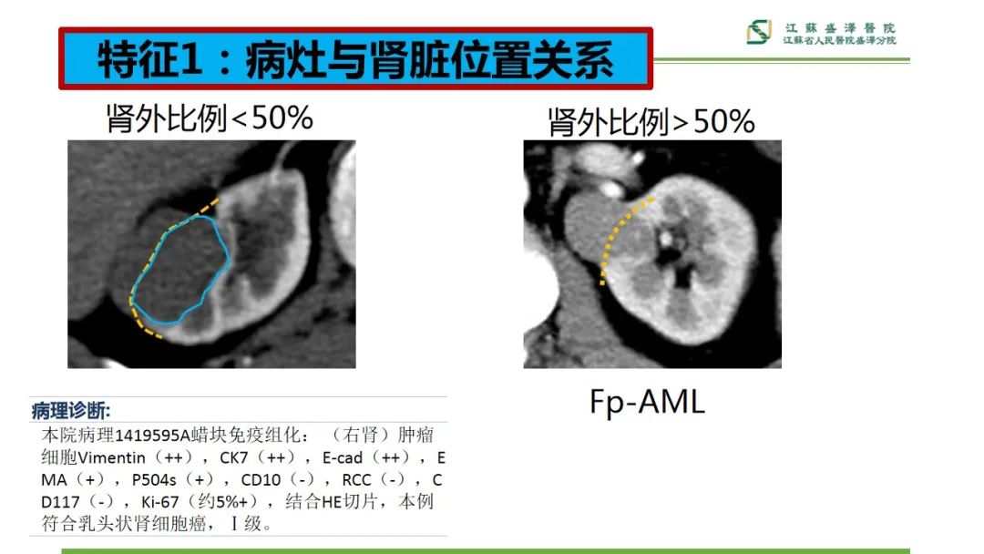 影像PPT - 【PPT】肾脏实性肿瘤的良恶性鉴别--影像诊断思路分析-9