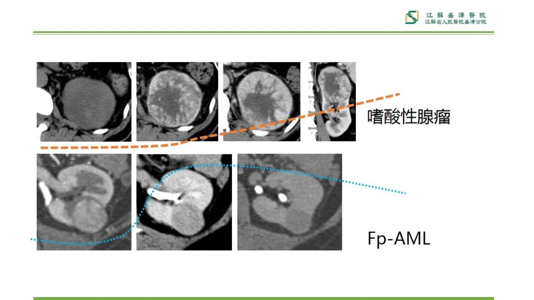 影像PPT - 【PPT】肾脏实性肿瘤的良恶性鉴别--影像诊断思路分析-13