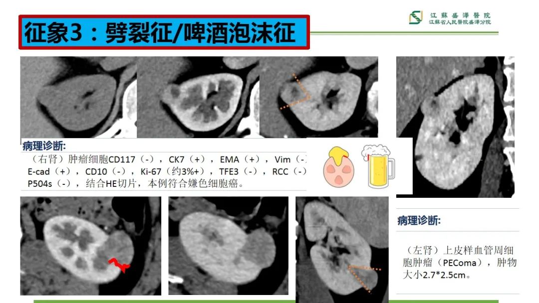 影像PPT - 【PPT】肾脏实性肿瘤的良恶性鉴别--影像诊断思路分析-15