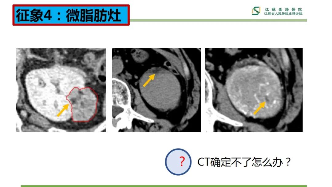 影像PPT - 【PPT】肾脏实性肿瘤的良恶性鉴别--影像诊断思路分析-17