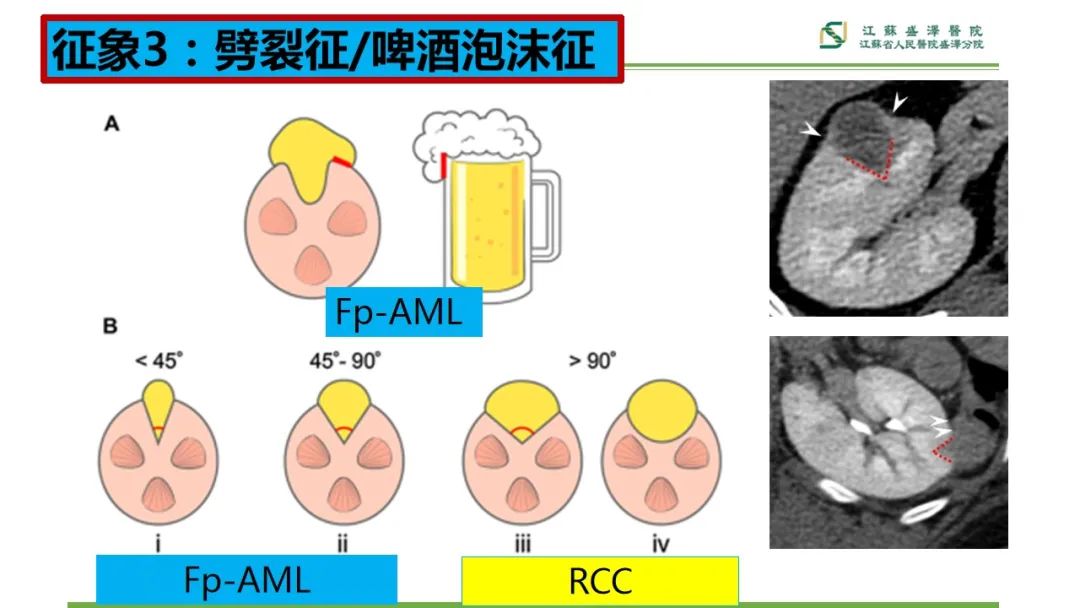 影像PPT - 【PPT】肾脏实性肿瘤的良恶性鉴别--影像诊断思路分析-14