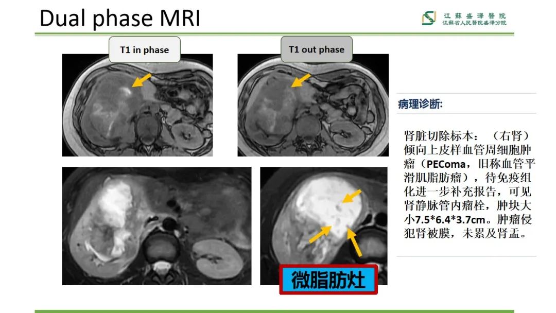 影像PPT - 【PPT】肾脏实性肿瘤的良恶性鉴别--影像诊断思路分析-19