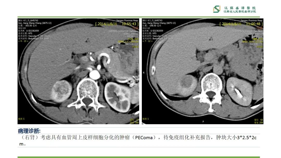 影像PPT - 【PPT】肾脏实性肿瘤的良恶性鉴别--影像诊断思路分析-23