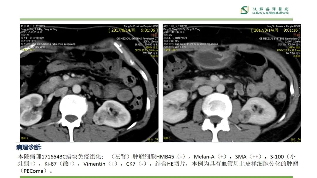 影像PPT - 【PPT】肾脏实性肿瘤的良恶性鉴别--影像诊断思路分析-21