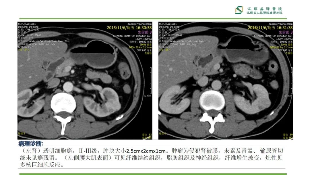 影像PPT - 【PPT】肾脏实性肿瘤的良恶性鉴别--影像诊断思路分析-22