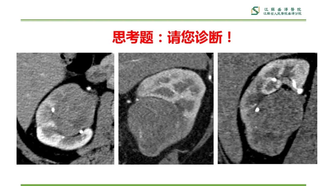 影像PPT - 【PPT】肾脏实性肿瘤的良恶性鉴别--影像诊断思路分析-25