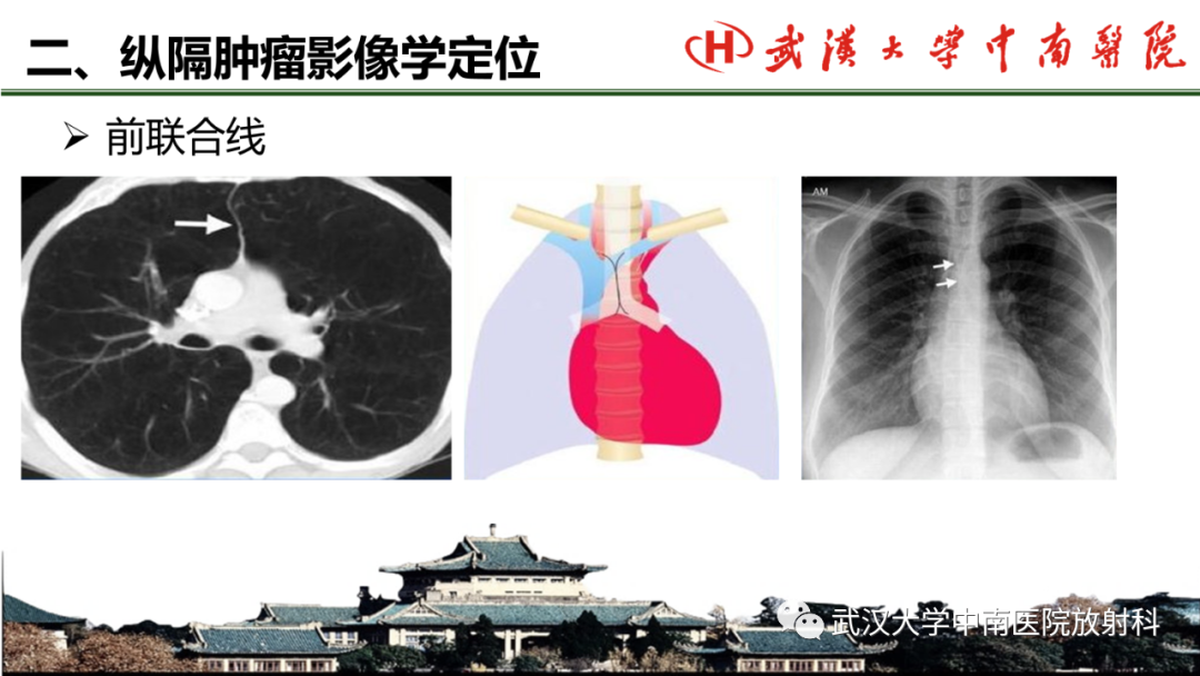 影像PPT - 【PPT】纵隔影像解剖、纵隔肿瘤定位及前纵隔肿瘤和瘤样病变-6