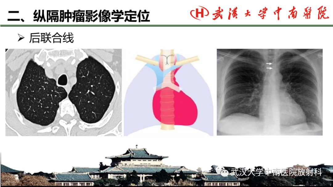 影像PPT - 【PPT】纵隔影像解剖、纵隔肿瘤定位及前纵隔肿瘤和瘤样病变-7