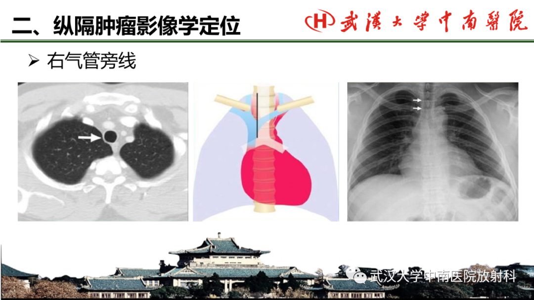 影像PPT - 【PPT】纵隔影像解剖、纵隔肿瘤定位及前纵隔肿瘤和瘤样病变-8