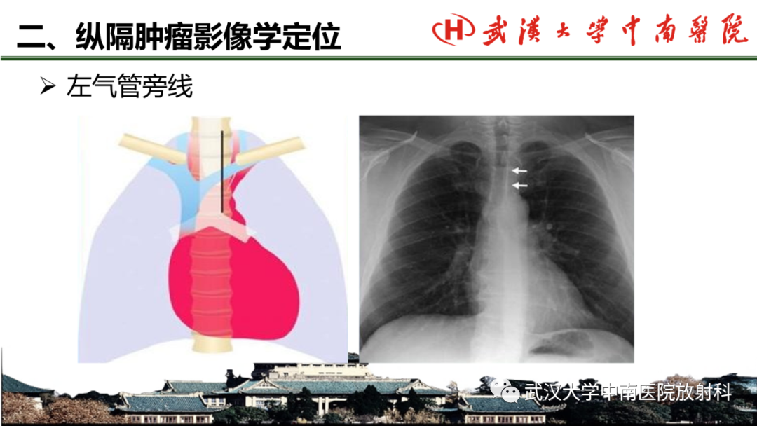 影像PPT - 【PPT】纵隔影像解剖、纵隔肿瘤定位及前纵隔肿瘤和瘤样病变-10
