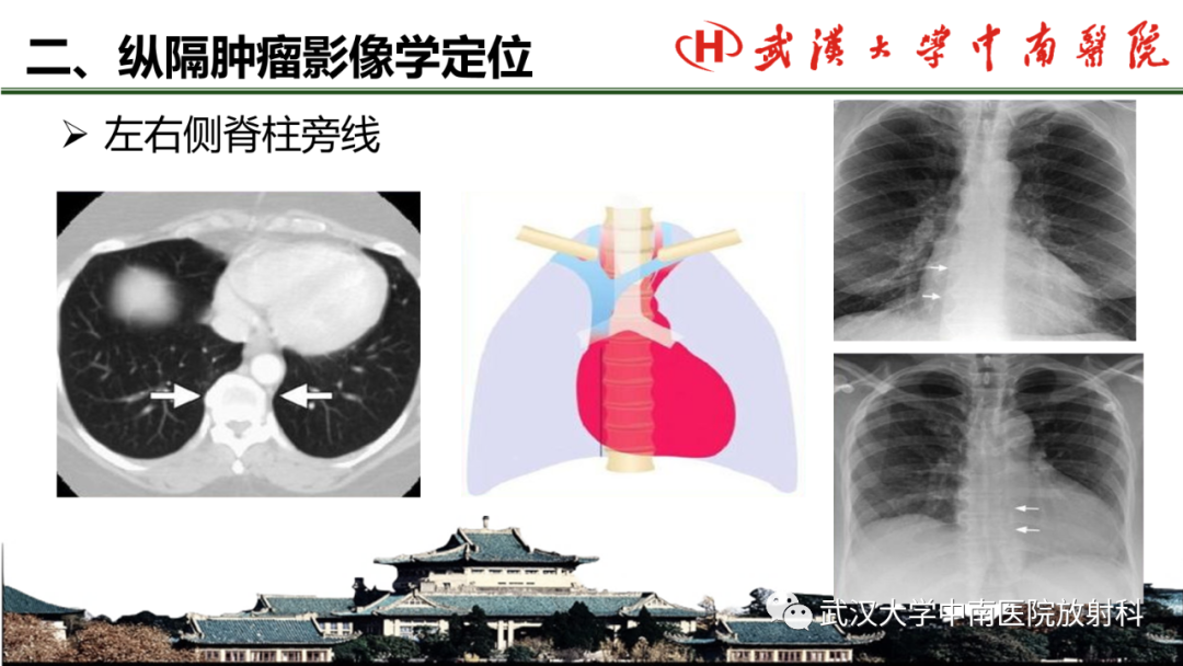 影像PPT - 【PPT】纵隔影像解剖、纵隔肿瘤定位及前纵隔肿瘤和瘤样病变-12
