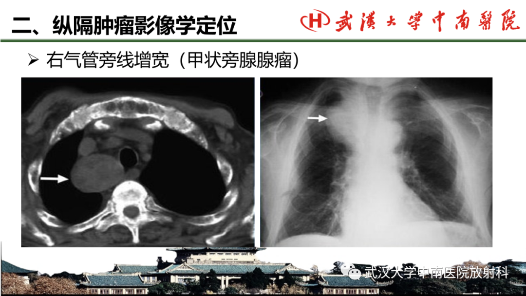 影像PPT - 【PPT】纵隔影像解剖、纵隔肿瘤定位及前纵隔肿瘤和瘤样病变-9