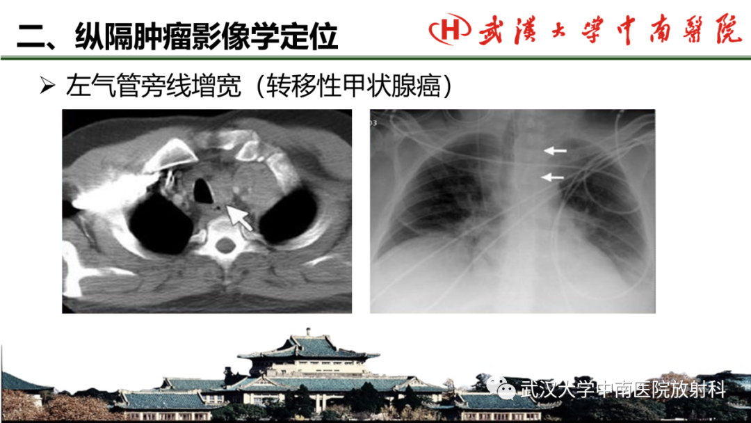 影像PPT - 【PPT】纵隔影像解剖、纵隔肿瘤定位及前纵隔肿瘤和瘤样病变-11