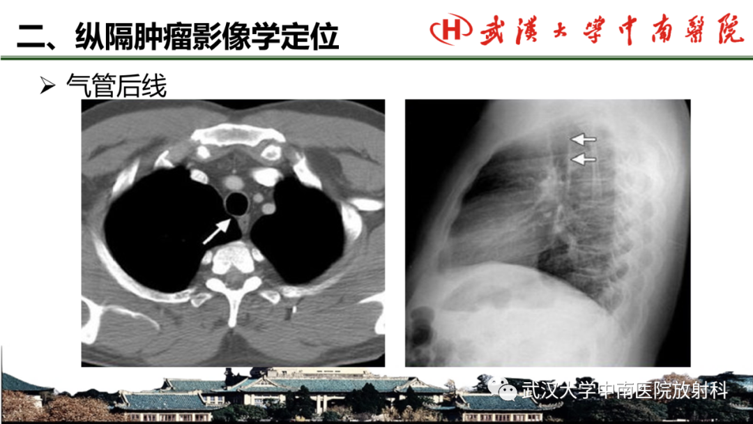 影像PPT - 【PPT】纵隔影像解剖、纵隔肿瘤定位及前纵隔肿瘤和瘤样病变-15