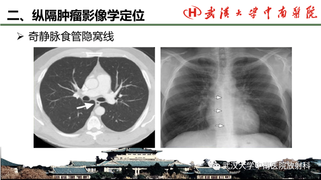 影像PPT - 【PPT】纵隔影像解剖、纵隔肿瘤定位及前纵隔肿瘤和瘤样病变-16