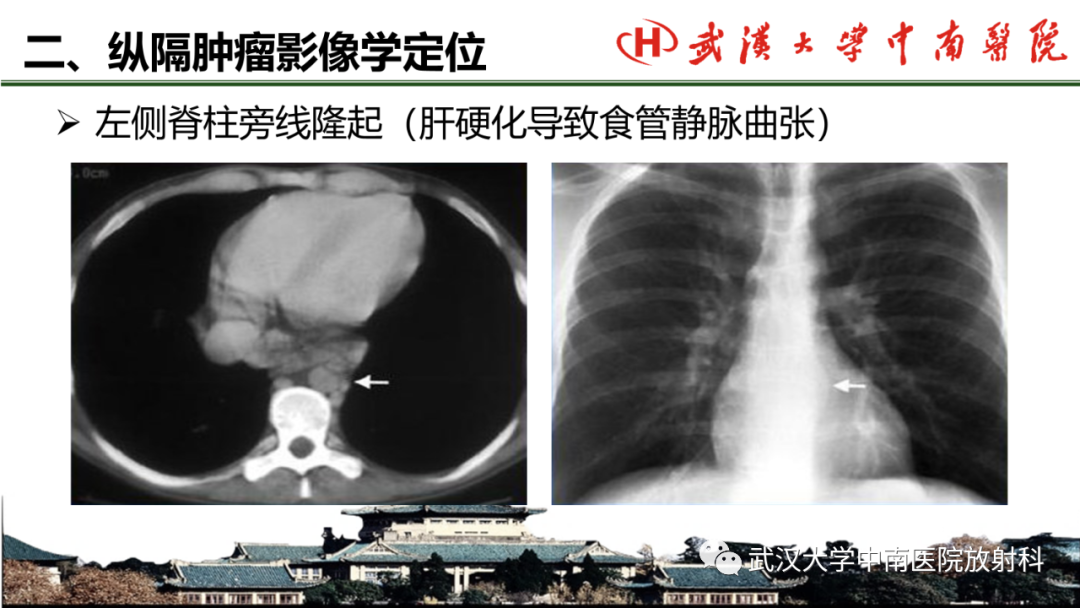 影像PPT - 【PPT】纵隔影像解剖、纵隔肿瘤定位及前纵隔肿瘤和瘤样病变-14