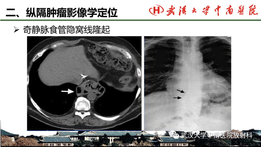 影像PPT - 【PPT】纵隔影像解剖、纵隔肿瘤定位及前纵隔肿瘤和瘤样病变-17