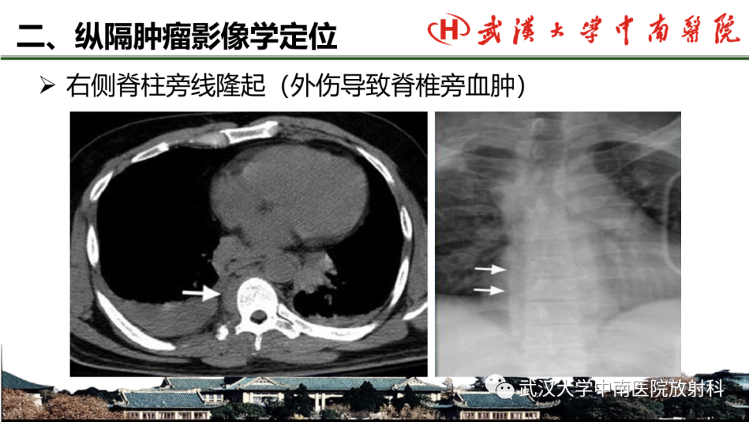 影像PPT - 【PPT】纵隔影像解剖、纵隔肿瘤定位及前纵隔肿瘤和瘤样病变-13