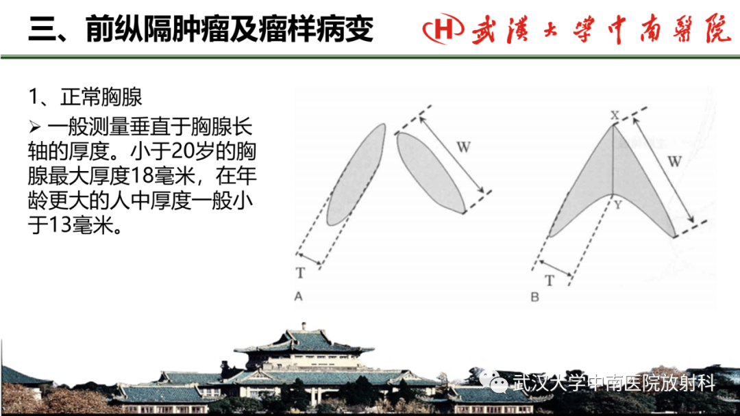 影像PPT - 【PPT】纵隔影像解剖、纵隔肿瘤定位及前纵隔肿瘤和瘤样病变-24