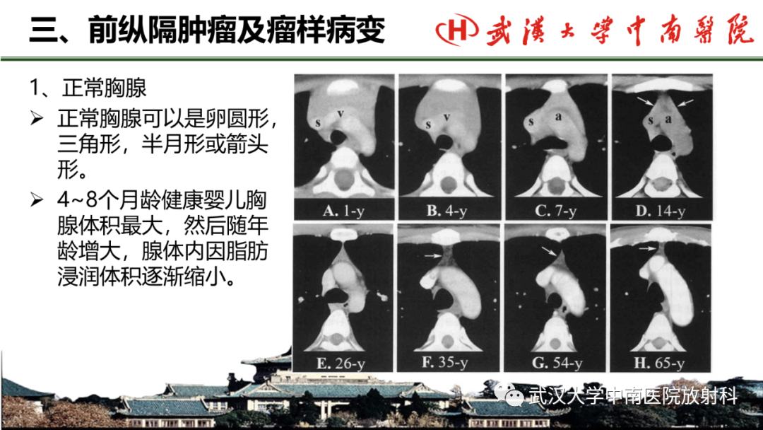 影像PPT - 【PPT】纵隔影像解剖、纵隔肿瘤定位及前纵隔肿瘤和瘤样病变-23