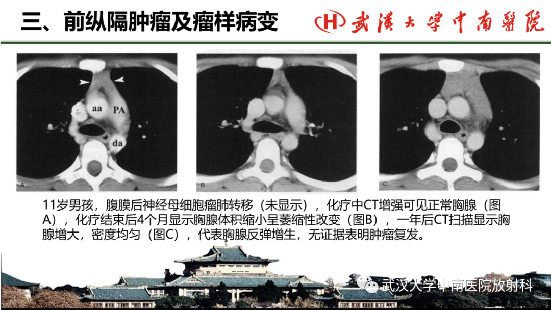 影像PPT - 【PPT】纵隔影像解剖、纵隔肿瘤定位及前纵隔肿瘤和瘤样病变-26