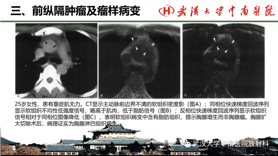 影像PPT - 【PPT】纵隔影像解剖、纵隔肿瘤定位及前纵隔肿瘤和瘤样病变-28