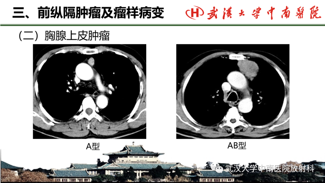 影像PPT - 【PPT】纵隔影像解剖、纵隔肿瘤定位及前纵隔肿瘤和瘤样病变-33