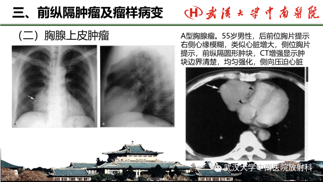 影像PPT - 【PPT】纵隔影像解剖、纵隔肿瘤定位及前纵隔肿瘤和瘤样病变-32