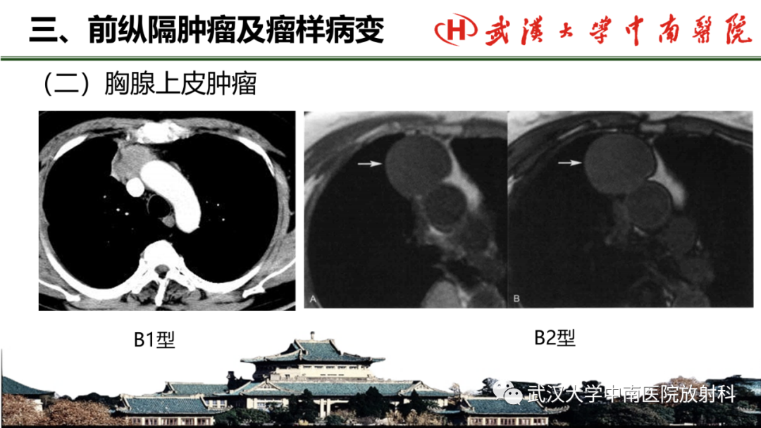 影像PPT - 【PPT】纵隔影像解剖、纵隔肿瘤定位及前纵隔肿瘤和瘤样病变-34