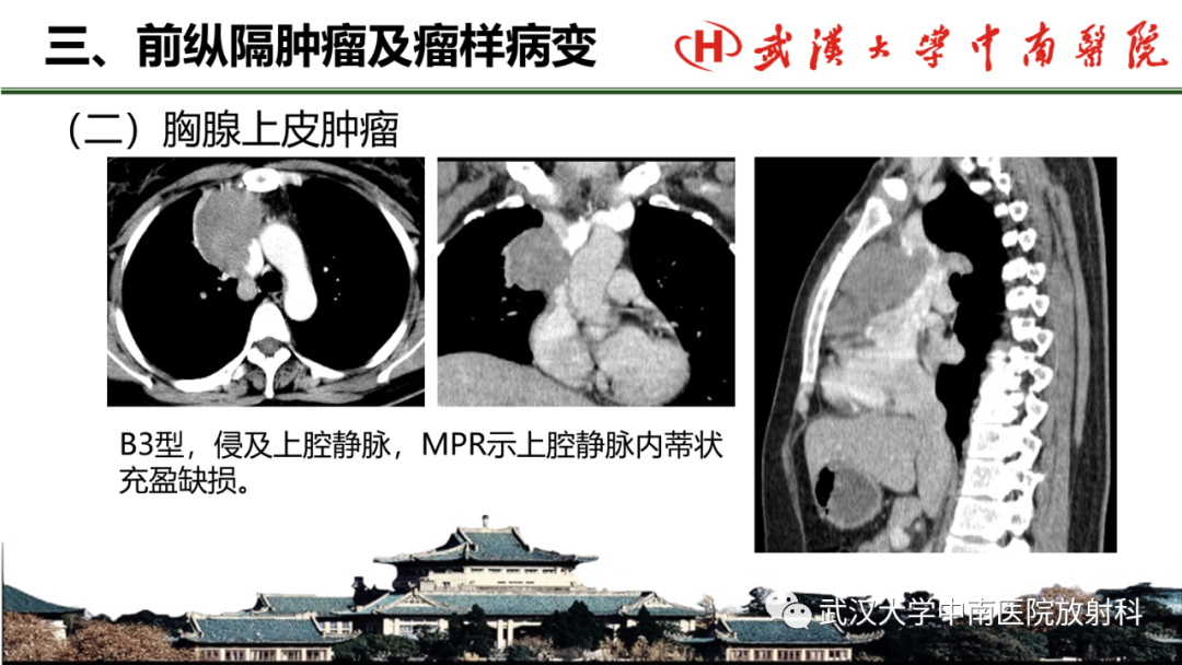 影像PPT - 【PPT】纵隔影像解剖、纵隔肿瘤定位及前纵隔肿瘤和瘤样病变-35