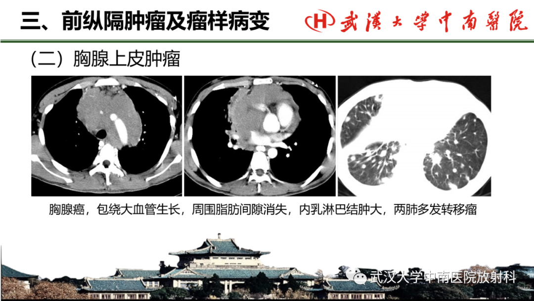 影像PPT - 【PPT】纵隔影像解剖、纵隔肿瘤定位及前纵隔肿瘤和瘤样病变-36