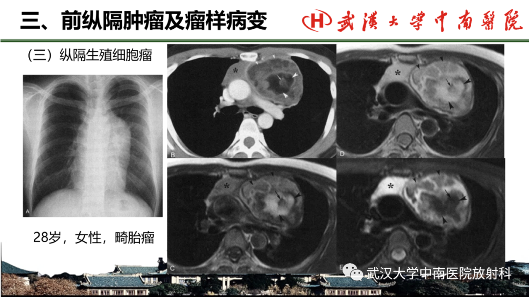 影像PPT - 【PPT】纵隔影像解剖、纵隔肿瘤定位及前纵隔肿瘤和瘤样病变-41