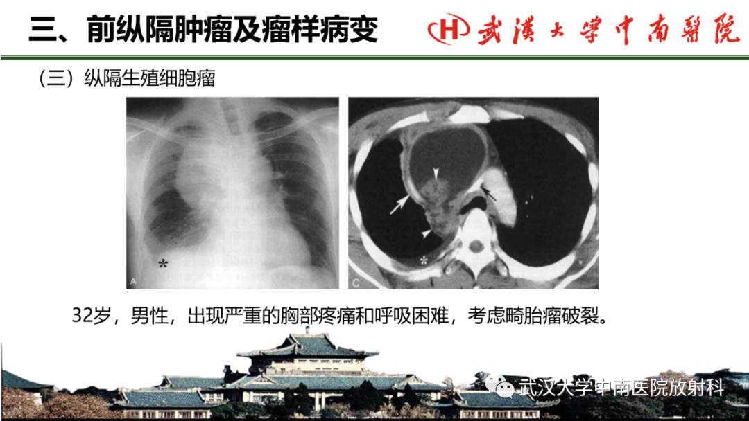 影像PPT - 【PPT】纵隔影像解剖、纵隔肿瘤定位及前纵隔肿瘤和瘤样病变-42