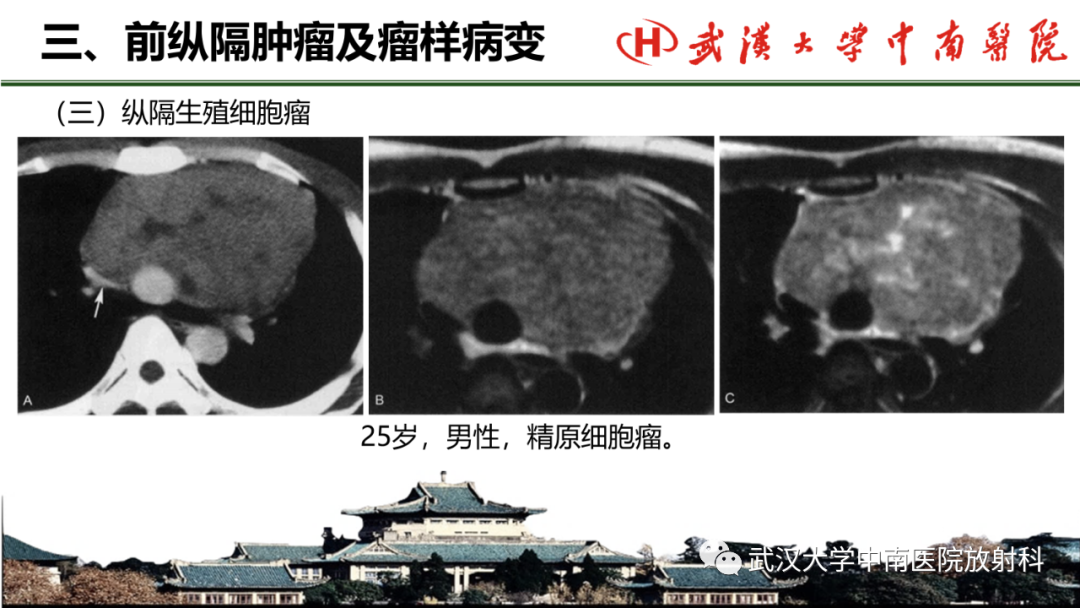 影像PPT - 【PPT】纵隔影像解剖、纵隔肿瘤定位及前纵隔肿瘤和瘤样病变-44