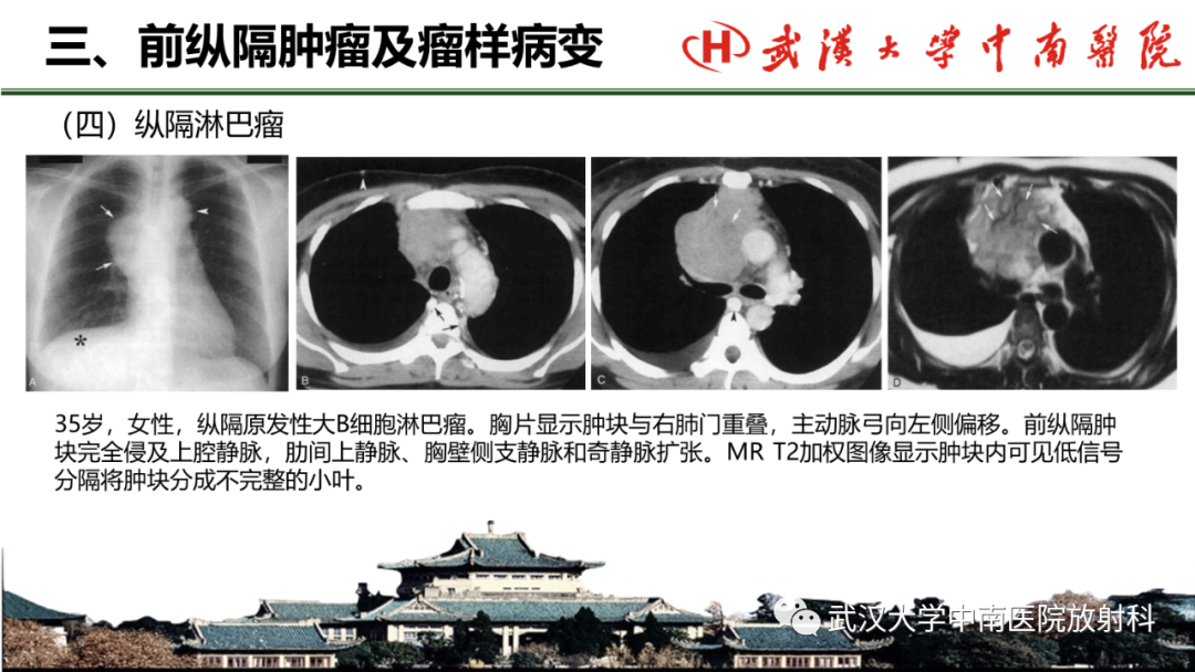 影像PPT - 【PPT】纵隔影像解剖、纵隔肿瘤定位及前纵隔肿瘤和瘤样病变-47