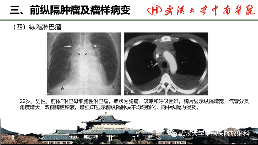 影像PPT - 【PPT】纵隔影像解剖、纵隔肿瘤定位及前纵隔肿瘤和瘤样病变-48