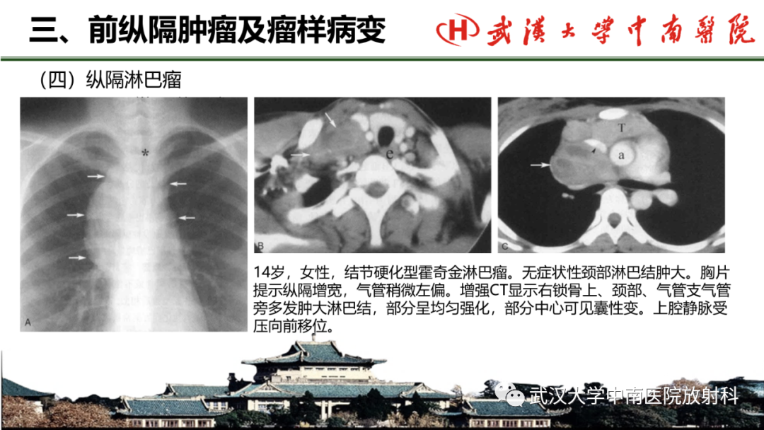 影像PPT - 【PPT】纵隔影像解剖、纵隔肿瘤定位及前纵隔肿瘤和瘤样病变-49