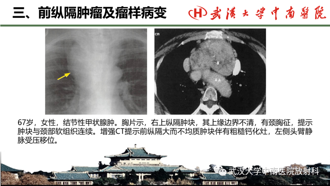 影像PPT - 【PPT】纵隔影像解剖、纵隔肿瘤定位及前纵隔肿瘤和瘤样病变-52