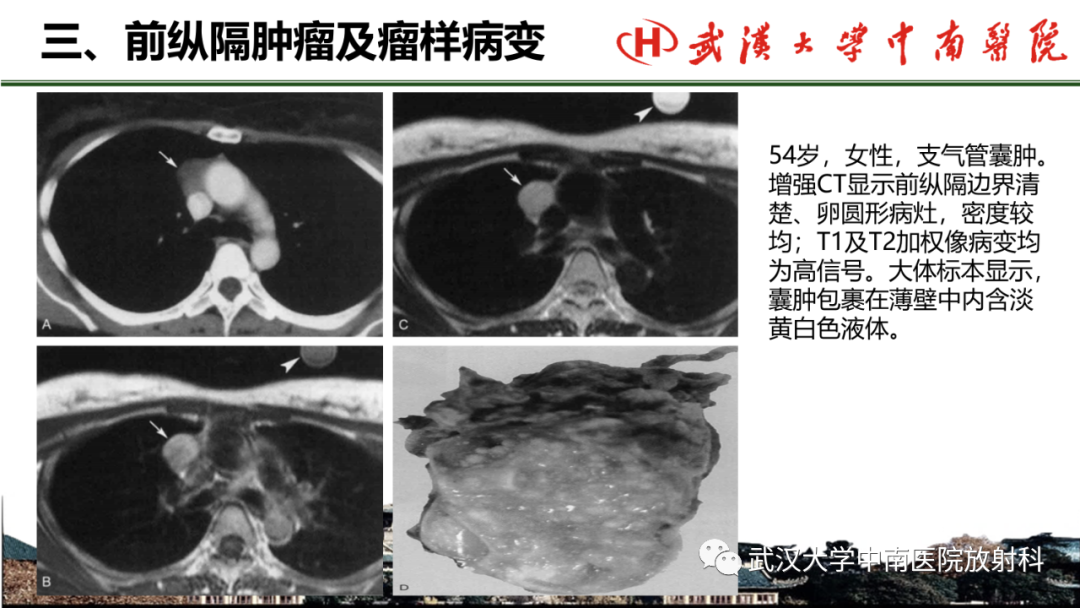 影像PPT - 【PPT】纵隔影像解剖、纵隔肿瘤定位及前纵隔肿瘤和瘤样病变-57
