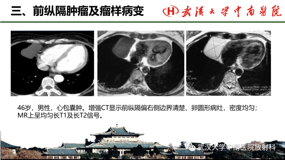 影像PPT - 【PPT】纵隔影像解剖、纵隔肿瘤定位及前纵隔肿瘤和瘤样病变-59